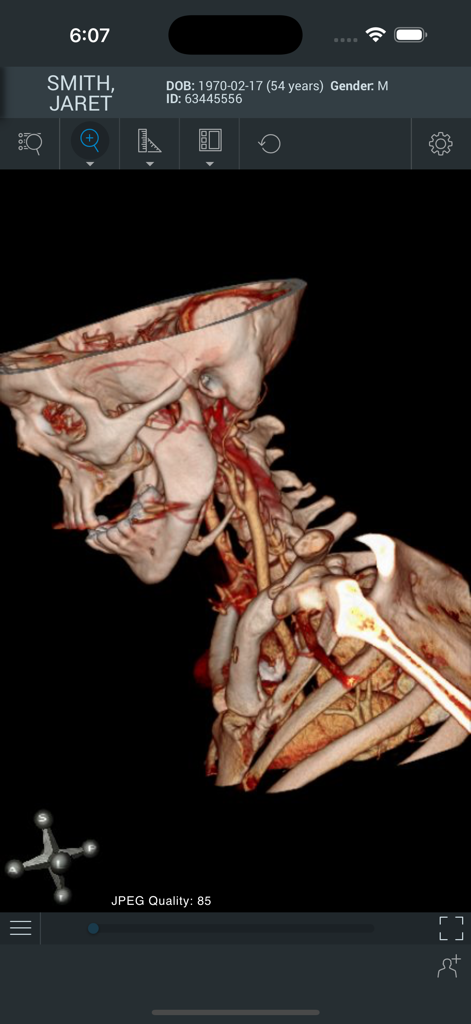 ResolutionMD - A 3D anatomical rendering of a patient skull and neck in the ResolutionMD mobile application interface