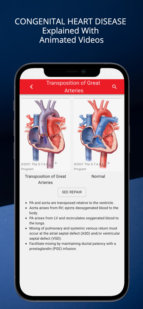 STABLEize - The STABLE Program - STABLEizeアプリのインターフェースに、正常な心臓と比較した大血管転位の医療図