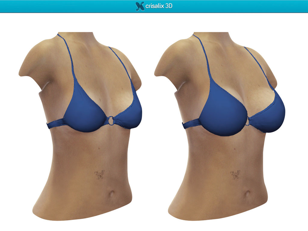 Crisalix - Simulación 3D lado a lado de un torso femenino que muestra resultados de aumento de pecho antes y después