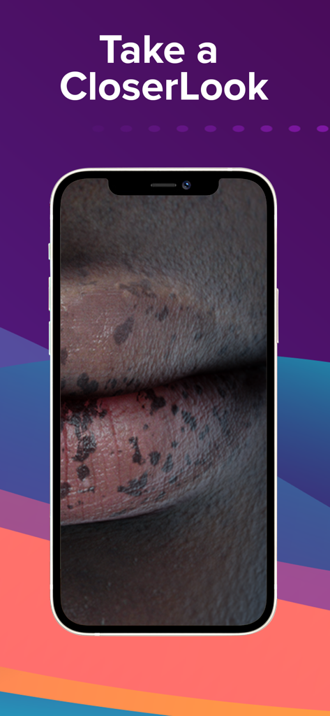 Eine Nahaufnahme einer Hauterkrankung auf den Lippen, die auf einem Smartphone-Bildschirm in der Top Derm App gezeigt wird