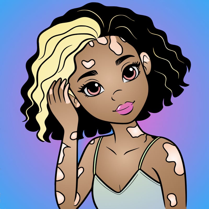 vitiligo black girl