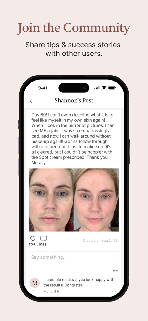 Musely - Uma tela de aplicativo móvel da Musely mostrando fotos de antes e depois da transformação da pele do usuário e comentários da comunidade