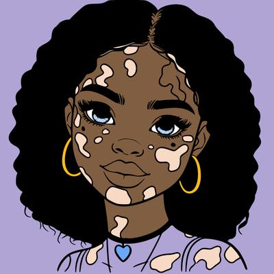 bleautiful black girl with vitiligo