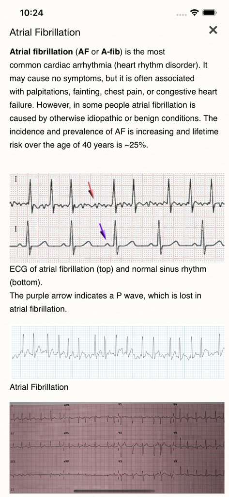 ECG Books Pro - Educational screen from ECG Books Pro showing a medical description and ECG strip comparison between Atrial Fibrillation and normal sinus rhythm