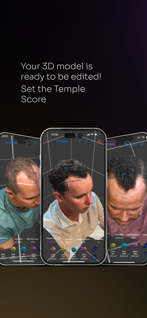 Three smartphones showing 3D scalp models with hairline markings for hair transplant surgical planning and temple score settings