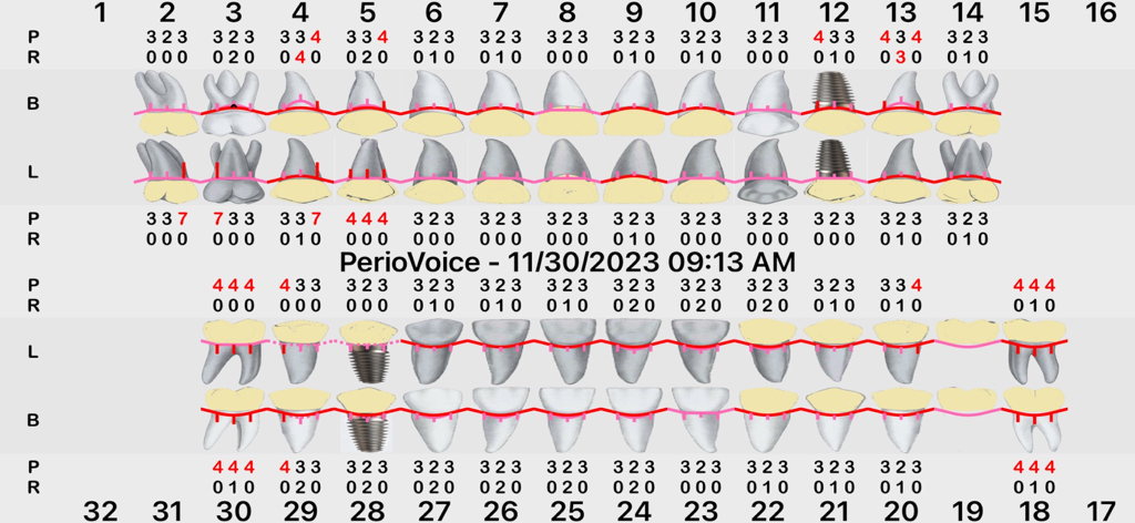 Gráfico periodontal digital mostrando medições clínicas e saúde dentária geradas pelo aplicativo PerioVoice Pro