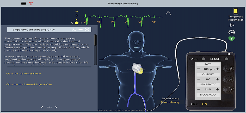 Temporary Cardiac Pacing - Interfaz de la aplicación de Estimulación Cardíaca Temporal que muestra un torso humano 3D con un modelo de corazón, una señal de ECG y un dispositivo de marcapasos virtual.