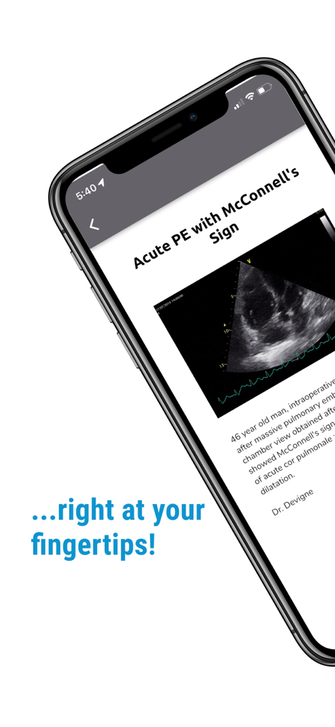 The POCUS Atlas app showing an ultrasound scan for Acute PE with McConnells Sign