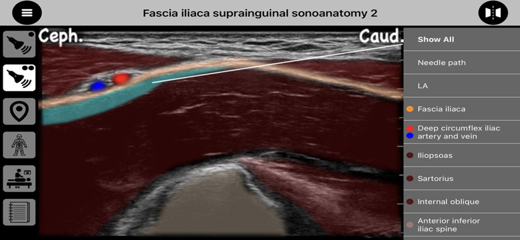 AnSo Pro - Exibição de ultrassom da sonoanatomia suprainguinal da fáscia ilíaca com sobreposições anatômicas codificadas por cores