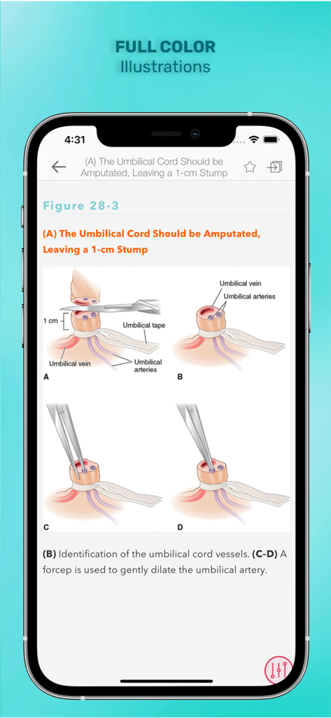 Gomella's Neonatology - Step by step medical illustration of umbilical cord amputation and vessel identification within the Gomella's Neonatology app