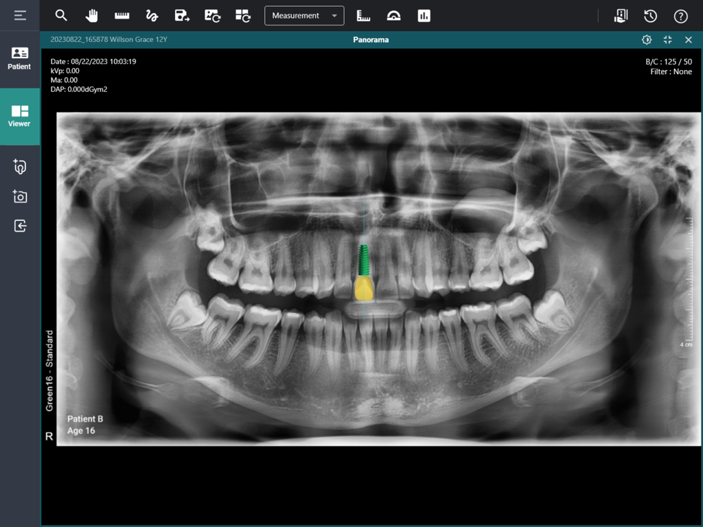 Un rayo X dental panorámico que muestra una simulación de implante dental resaltada dentro de la interfaz de diagnóstico de EzDent Web.