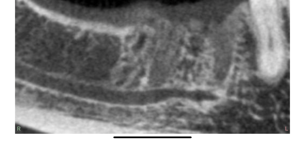 Dental CT View - A detailed panoramic dental CT scan of a jaw showing bone and tooth structure