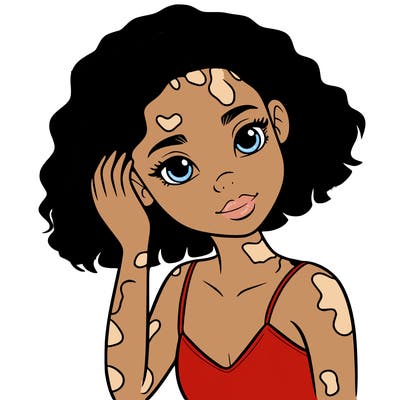 vitiligo black girl