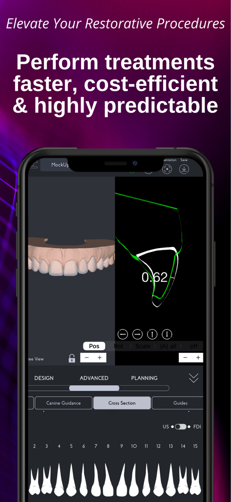 SmileFy TNG - Interfaz de la aplicación SmileFy TNG en un smartphone que muestra modelado de dientes 3D y análisis de corte transversal para procedimientos dentales restauradores