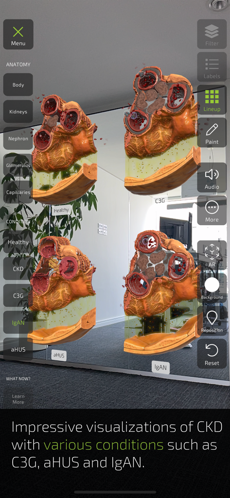 INSIGHT KIDNEY - Augmented reality visualization comparing healthy kidneys with rare diseases like C3G and IgAN