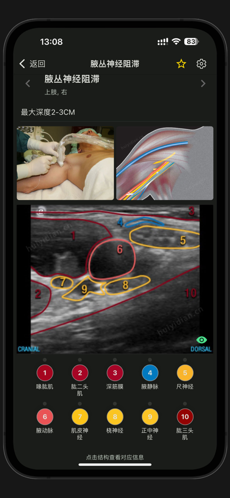 Anatomical guide for brachial plexus nerve block with ultrasound scan and labeled overlays