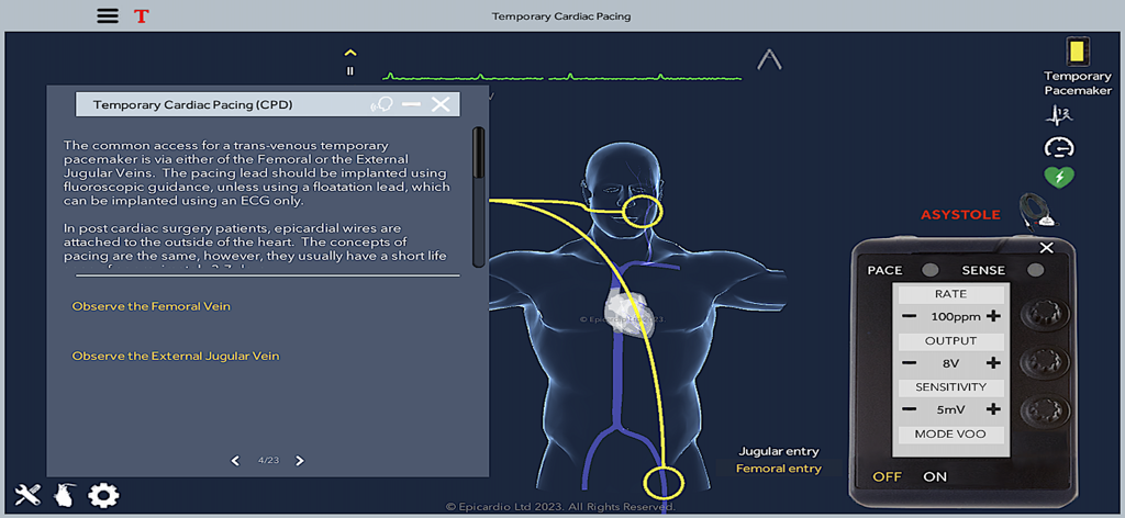 Temporary Cardiac Pacing - Interfaz de la aplicación de Estimulación Cardíaca Temporal con un modelo anatómico 3D y controles virtuales del marcapasos