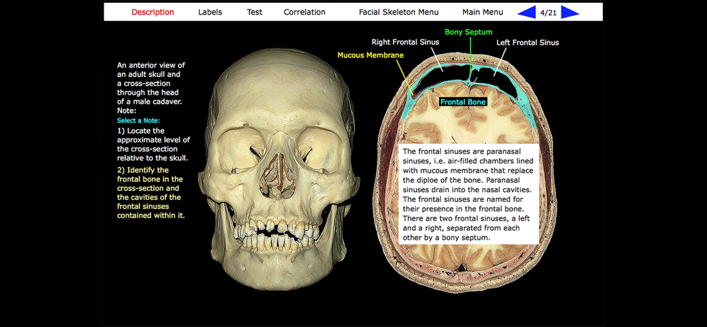 Vista anatomica di un cranio umano e una sezione trasversale che etichetta i seni frontali e il setto osseo.