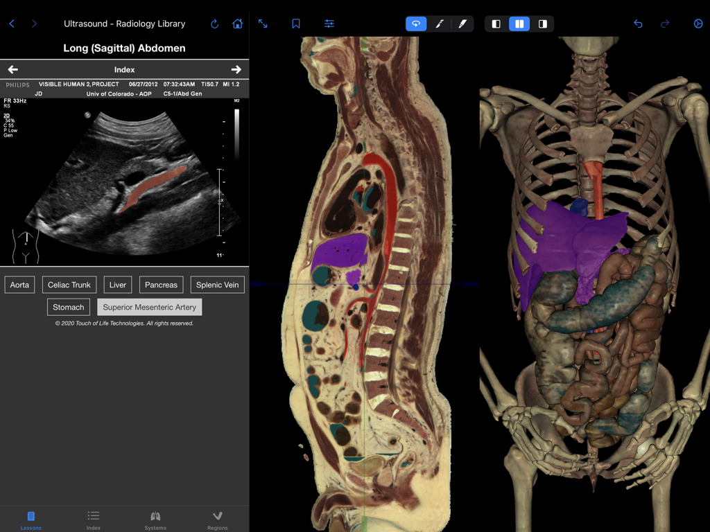 VH Dissector Pro - VH Dissector Pro interface showing a split-screen view of an abdominal ultrasound sagittal anatomical cross-section and 3D skeletal model