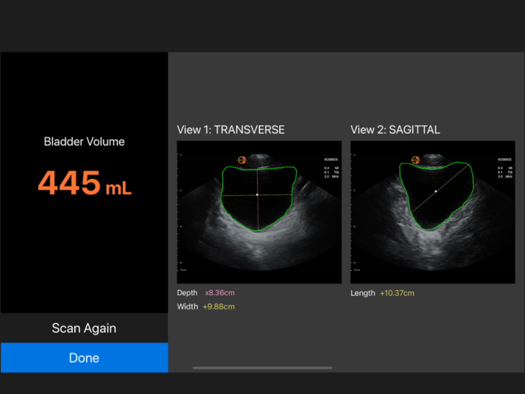 Kosmos Ultrasound 4.0 - Bladder volume measurement screen in the Kosmos Ultrasound app showing transverse and sagittal ultrasound scans