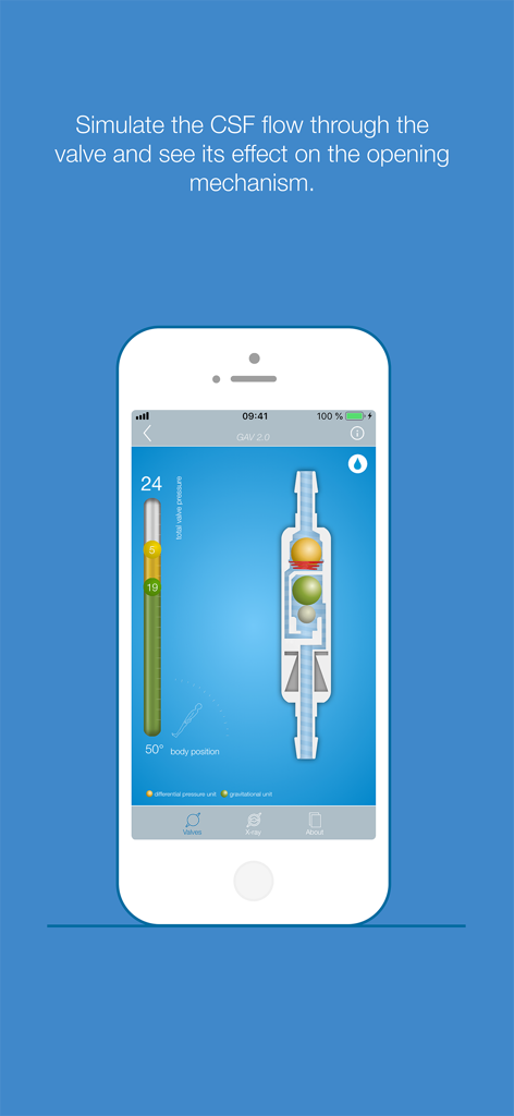 MIETHKE - Simulation of CSF flow through a GAV 2.0 gravitational valve at a 50 degree body position on the MIETHKE app