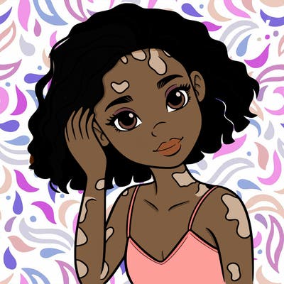 vitiligo black girl