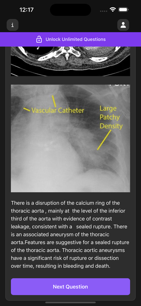 Labeled chest X-ray with detailed medical explanation of thoracic aorta findings in the Basic Radiology app