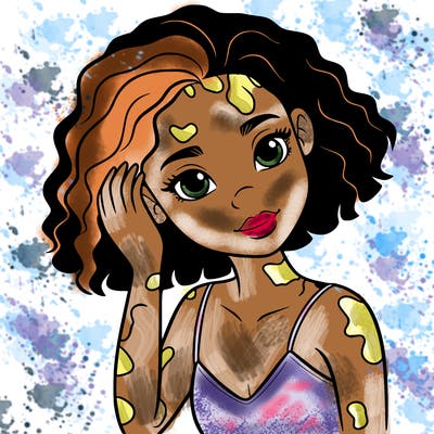 vitiligo black girl