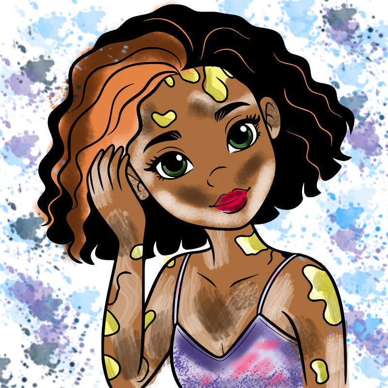 vitiligo black girl