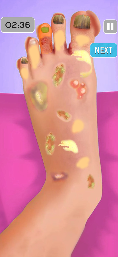 ASMR Foot Care: Doctor Games - A virtual foot with blisters and nail issues in the ASMR Foot Care doctor game