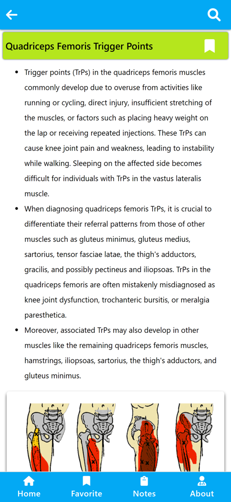 Physiotherapy Learning - Anatomische Diagramme und Informationen zu Triggerpunkten des M. quadriceps femoris in der Physiotherapie-Lern-App
