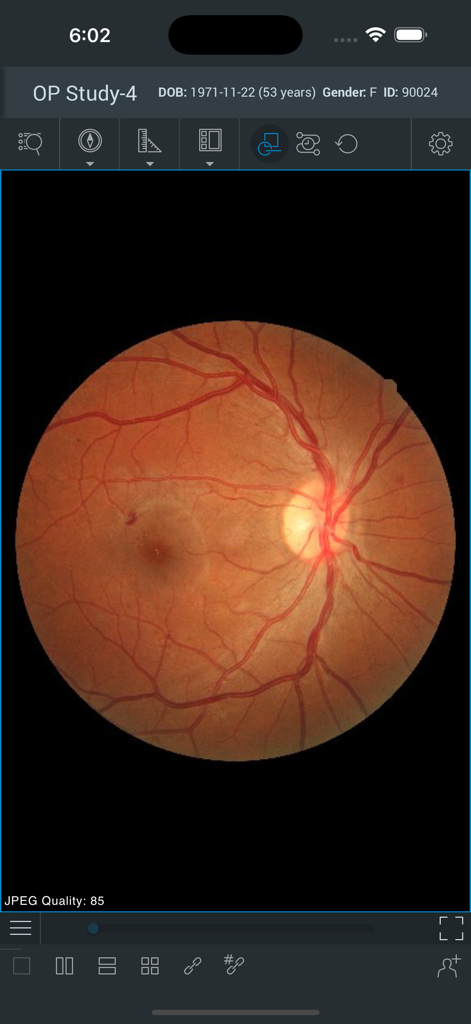 ResolutionMD - Retinal scan displayed on the ResolutionMD medical imaging app interface