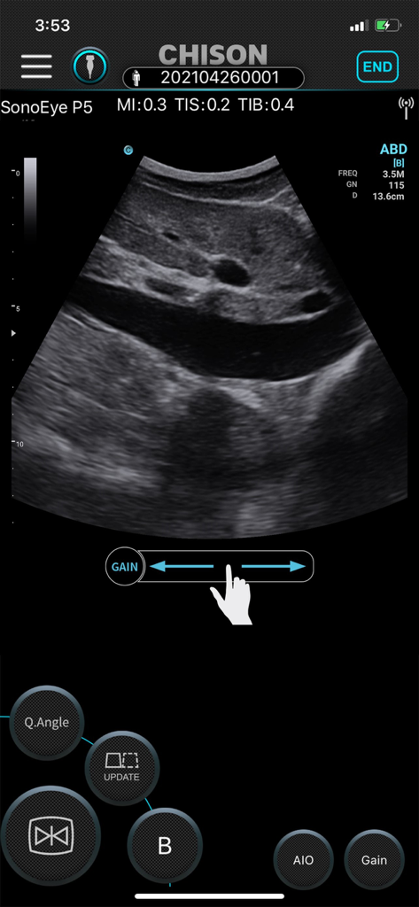 SonoEye - Interface do aplicativo SonoEye mostrando um ultrassom abdominal ao vivo com controles de ajuste de ganho em um smartphone.