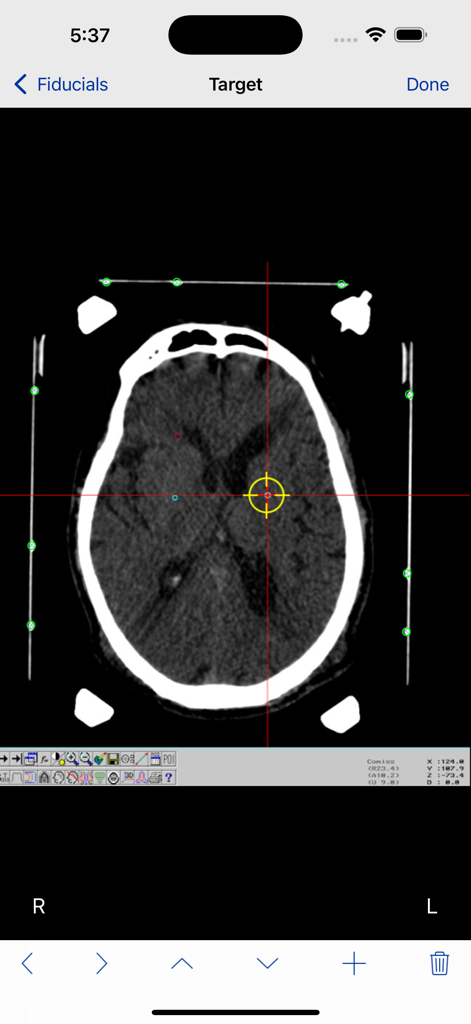 StereoCheck - Axial brain CT scan in StereoCheck app with target crosshair and fiducial points