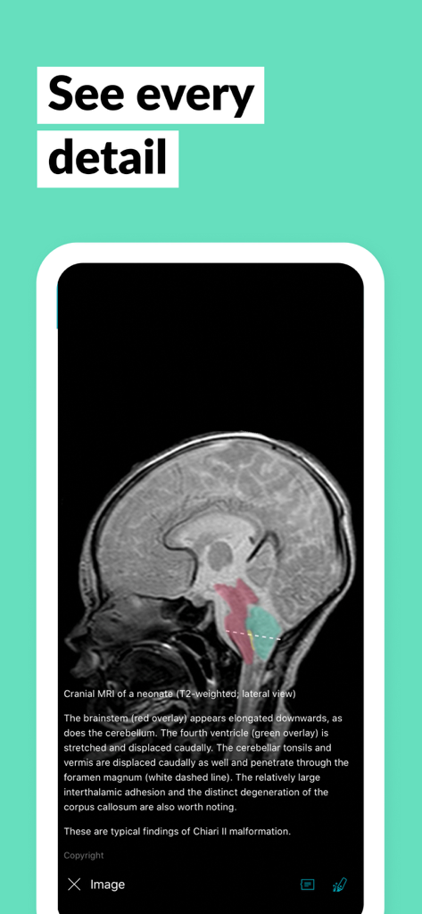 AMBOSS Qbank for Medical Exams - Interfaz de la aplicación AMBOSS Qbank que muestra una RM craneal con superposiciones diagnósticas y una explicación médica detallada