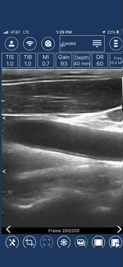EdgeLife - Imágenes de ultrasonido de la arteria carótida en la interfaz de la aplicación móvil EdgeLife