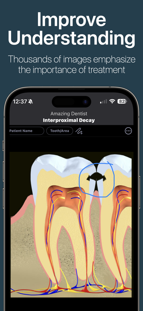DDS GP app interface showing a dental diagram of interproximal decay with annotations
