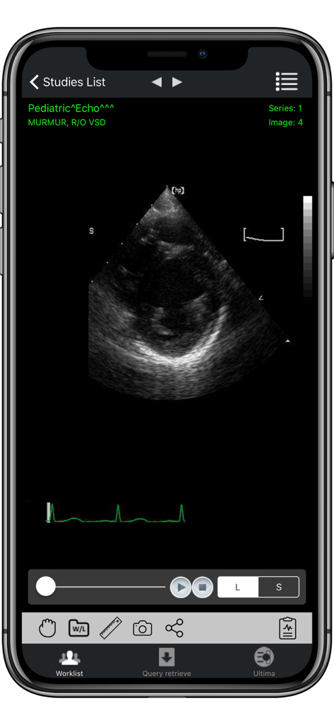 iPaxera app showing a pediatric echocardiogram on an iPhone with medical imaging tools