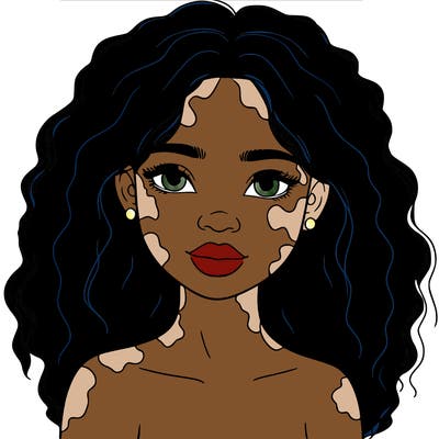 beautiful black girl with vitiligo