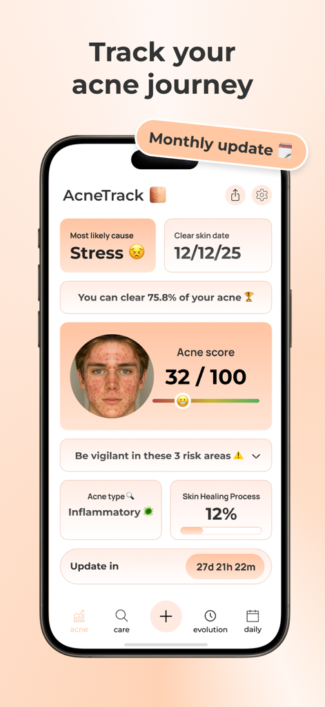 AcneTrack – Your Acne Journey - Dashboard dell'app mobile AcneTrack che mostra il punteggio dell'acne e il tracker dei progressi di guarigione della pelle.