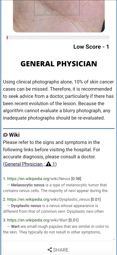 Model Dermatol - Wiki - Model Dermatol Wiki app displaying AI analysis results for a skin condition with links to medical references for nevus and warts