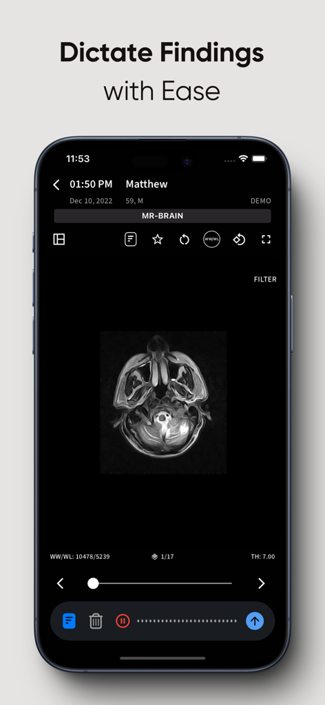 Smartphone screen displaying a brain MRI scan with a feature to dictate findings in the RadioView AI app