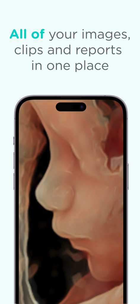 Una imagen de ecografía 3D de bebé mostrada en un smartphone usando la aplicación médica Pim