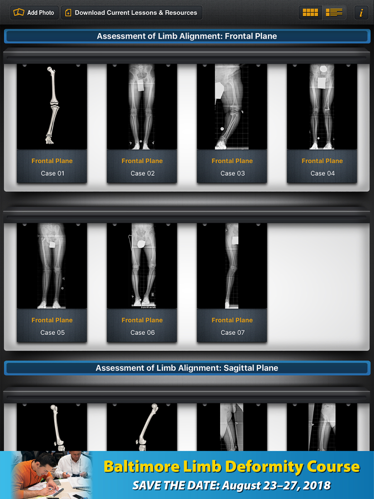 Bone Ninja app case library with X-rays for limb alignment assessment.