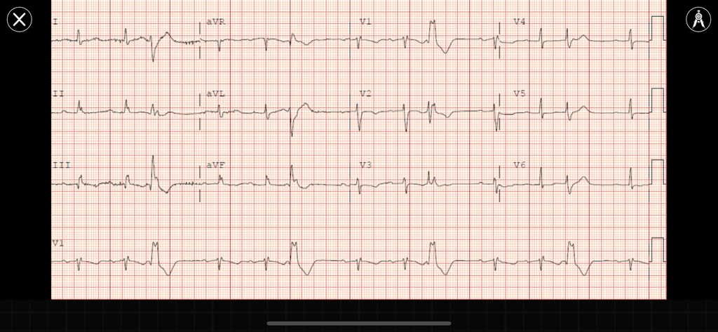 ECG Corner - A 12 lead electrocardiogram display on a grid background