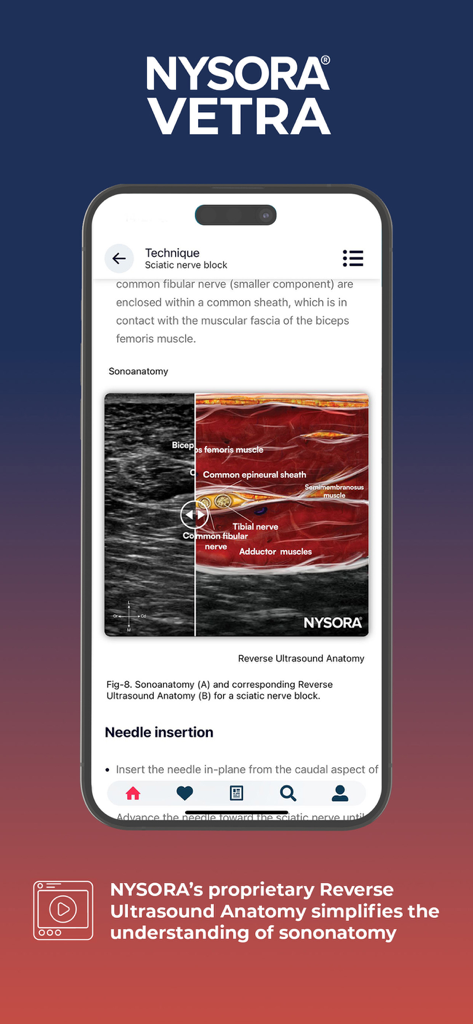 NYSORA VetRA - L'app NYSORA VetRA visualizza la tecnica del blocco del nervo sciatico con illustrazione anatomica a ultrasuoni inversi