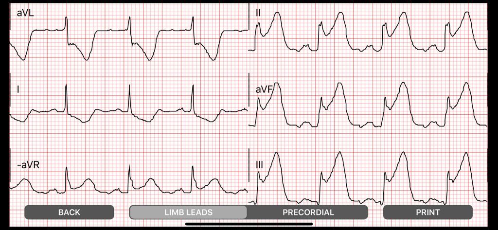 Medical Rescue Sim Pro - 12-lead ECG limb leads display in Medical Rescue Sim Pro simulation app