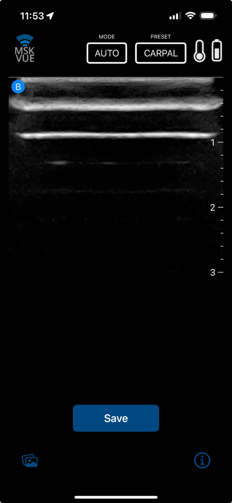 MSK VUE - Interface of the MSK VUE app displaying an ultrasound scan using the carpal preset for medical training.