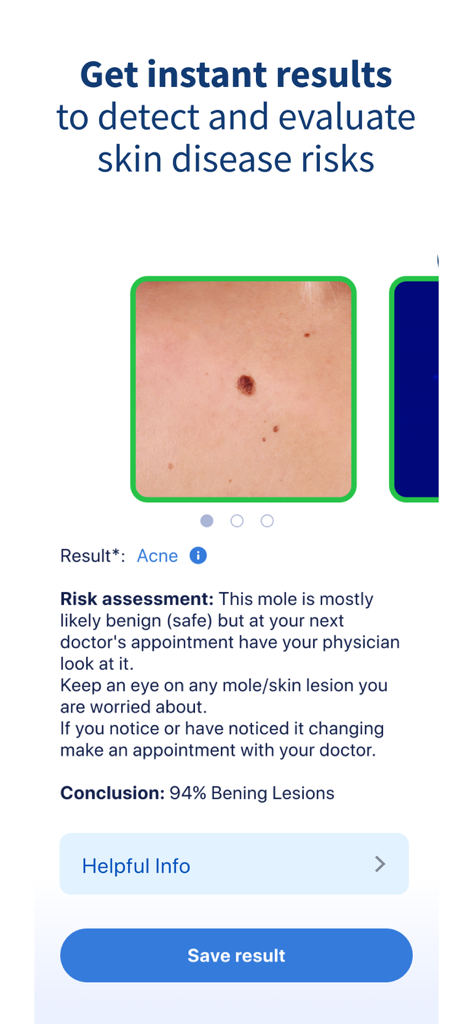 Schermata dell'app AI Dermatologist che visualizza il risultato di una scansione cutanea e la valutazione del rischio per un neo.