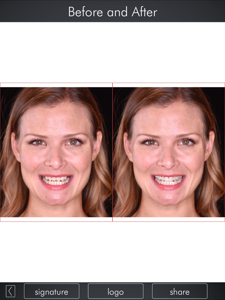Comparación lado a lado de la sonrisa de una mujer antes y después de usar la DSD App para simulación de diseño digital de sonrisa